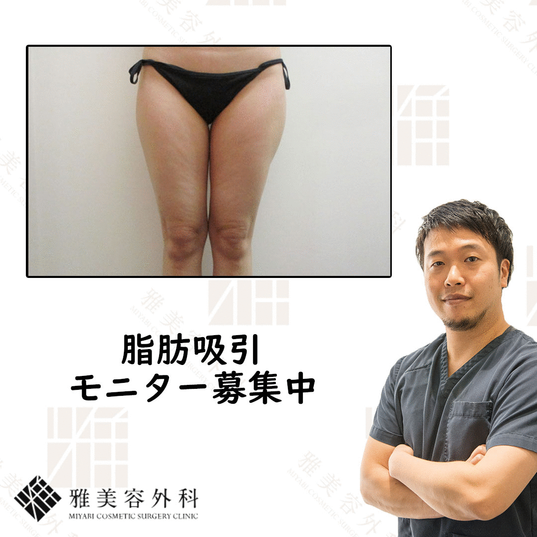 パンティラインgif ライン【Oさん】太もも｜脂肪吸引ブログ【大阪雅クリニック公式】