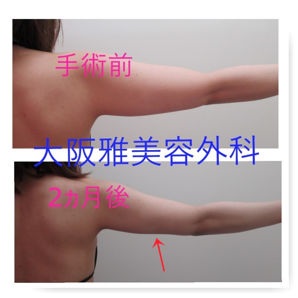 二の腕の脂肪吸引 Sさん 2ヶ月後 脂肪吸引ブログ 大阪雅クリニック公式