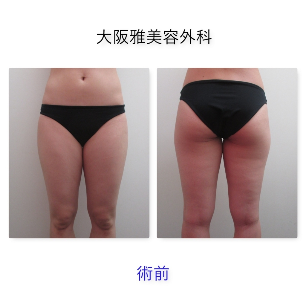 太もも内側の脂肪吸引 Yさん 1ヶ月 脂肪吸引ブログ 大阪雅クリニック公式